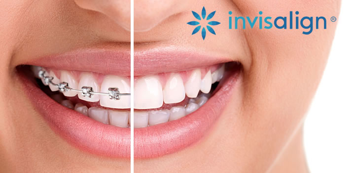 invisalign Whitby, Ajax, Pickering, Durham