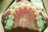 orthodontic treatment after