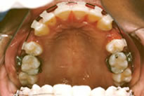 orthodontic treatment before