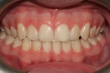 orthodontic treatment after