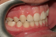 orthodontic treatment after