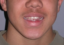 orthodontic treatment before