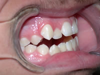 orthodontic treatment before