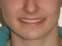 orthodontic treatment after