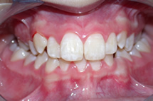 orthodontic treatment before