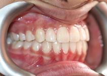 orthodontic treatment after