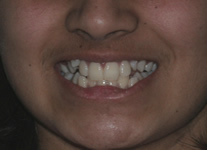 orthodontic treatment before