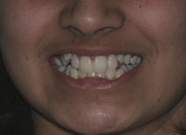 orthodontic treatment before