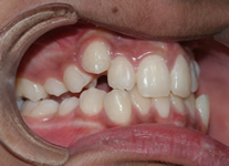 orthodontic treatment before