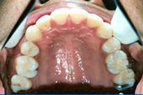 orthodontic treatment after