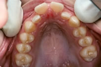 orthodontic treatment before