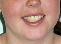 orthodontic treatment after