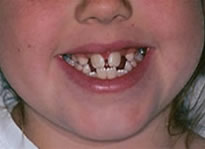 orthodontic treatment before