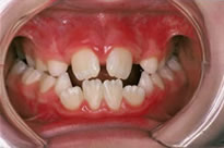 orthodontic treatment before