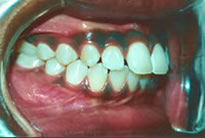 orthodontic treatment before