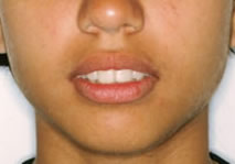 orthodontic treatment before