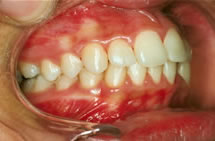 orthodontic treatment before