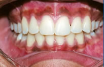 orthodontic treatment after