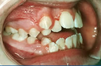 orthodontic treatment before