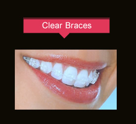 clear braces